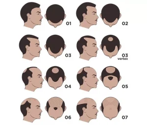 norwood hair scale